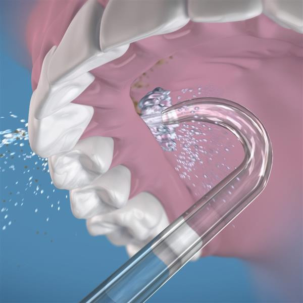 Waterpik Implant Denture Tip – náhradné trysky, 2 ks