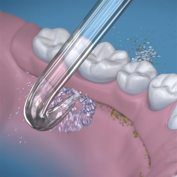 Waterpik Implant Denture Tip – náhradné trysky, 2 ks